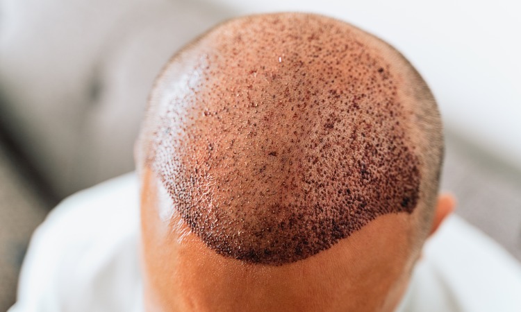 Body Hair Transplant