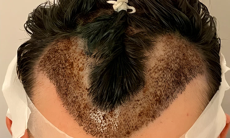 Partial-shave FUE